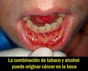 boca cáncer síntomas