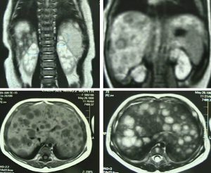 Síntomas del neuroblastoma