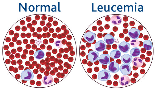 cáncer en la sangre o leucemia