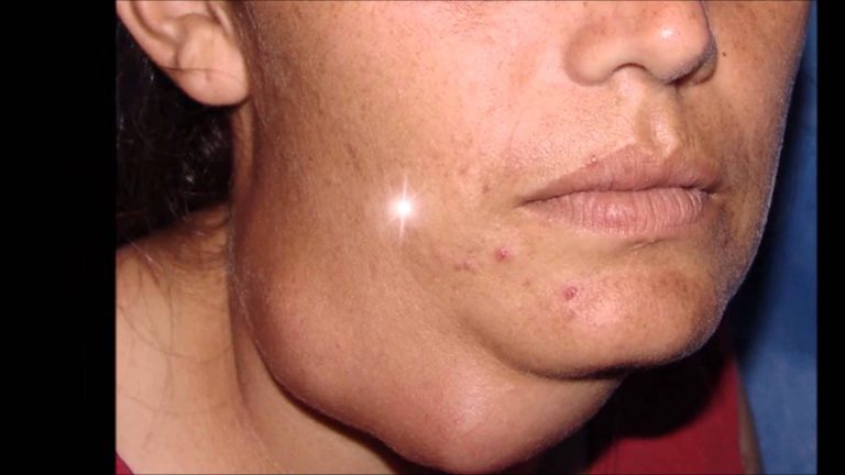 gládulas salivales cáncer