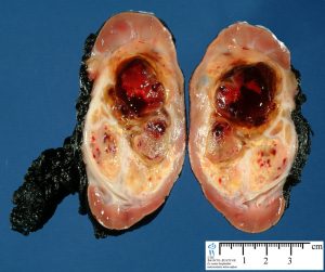 tumor Wilms2