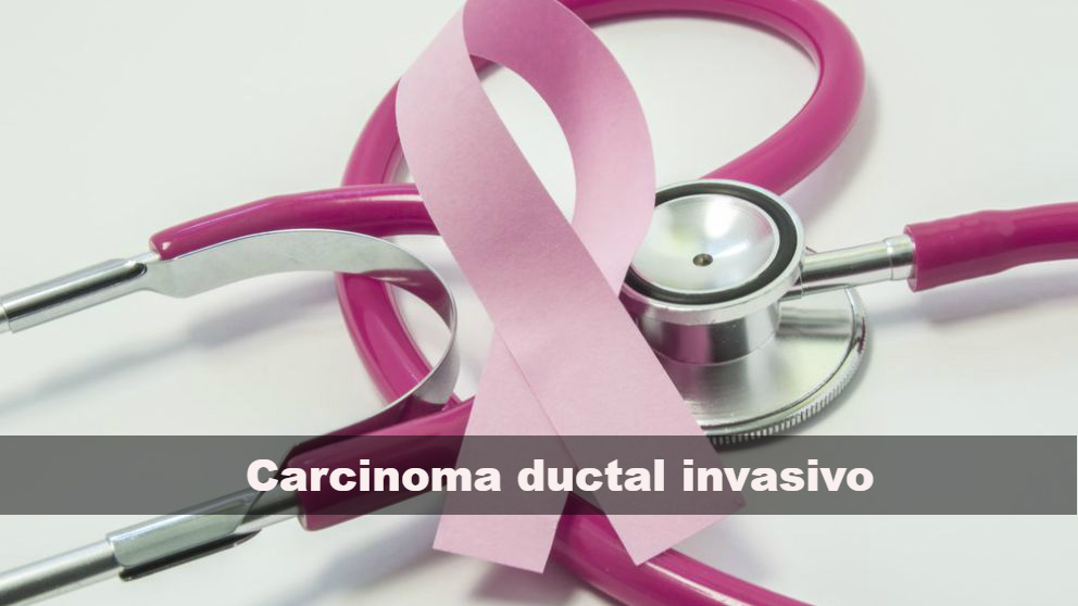 Qué es el carcinoma ductal invasivo