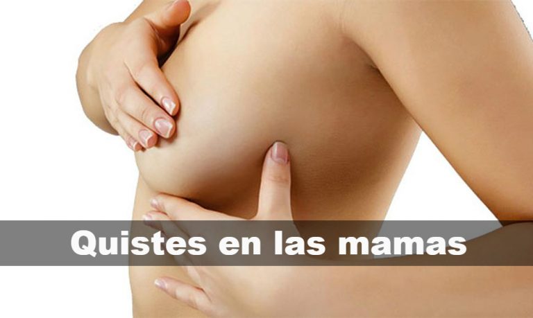 Qué son los quistes en las mamas