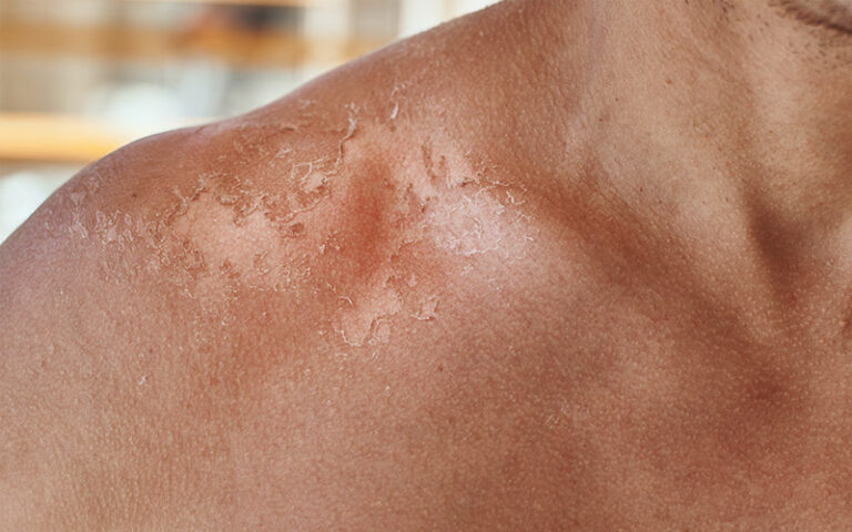 Protegerse del sol, imprescindible para mantener la piel sana y evitar el cáncer